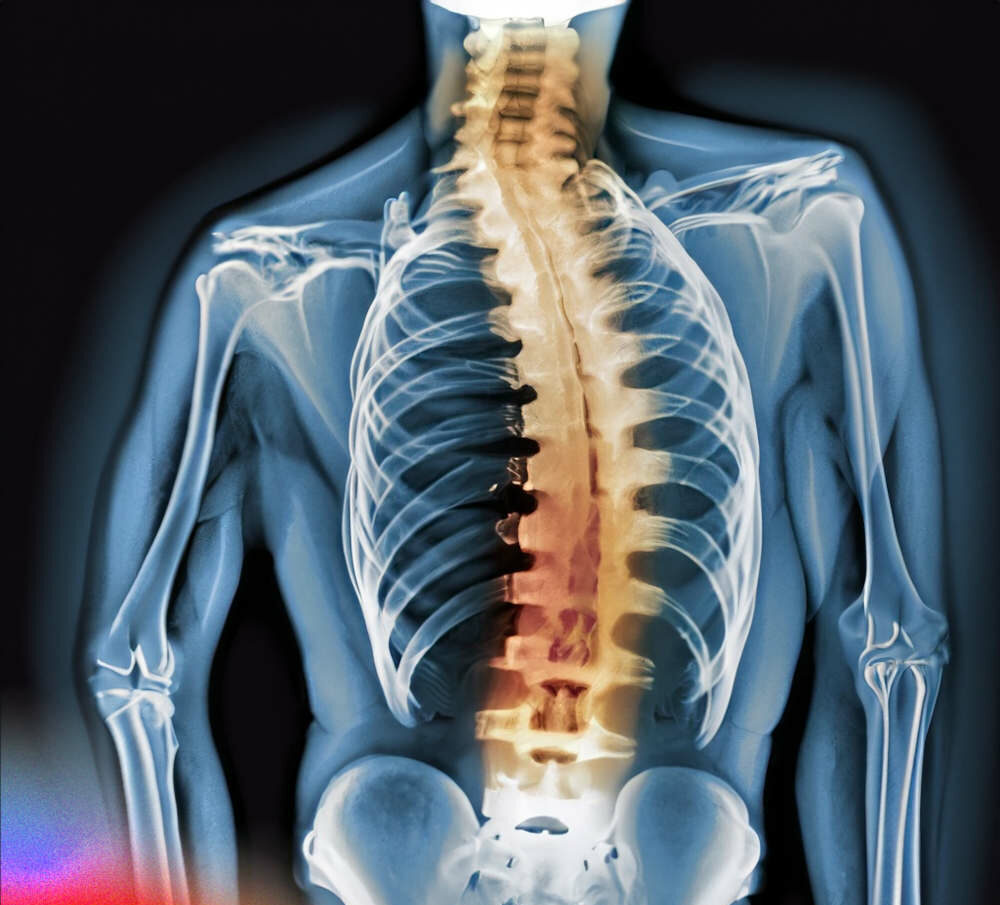 Radiografia scoliosi dorsale